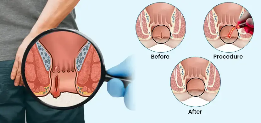 Fissure Treatment in Kolkata - Laser Fissure Surgery by Dr. Palash Mallick