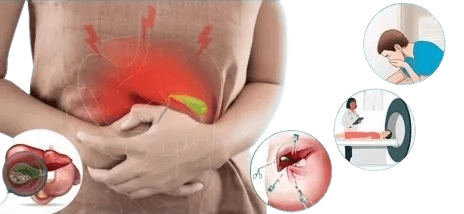 Gall Stone Surgery in Kolkata - Laparoscopic Gall Stone Surgery by Dr. Palash Mallick